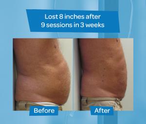 Healthy Weight Loss - Laser Lipo
