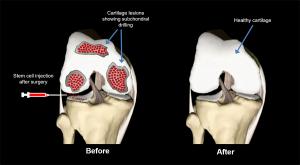 Regenerative Medicine for Cartilage