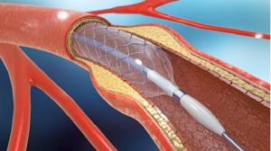 Esophageal Stents Market size, share , forecast