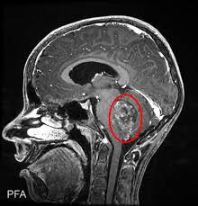 Ependymoma Market - By PMI