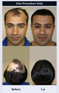 For the past 25 years, Dr. Brett Bolton has devoted his career exclusively to hair transplants and has consistently delivered unparalleled results to his patients.