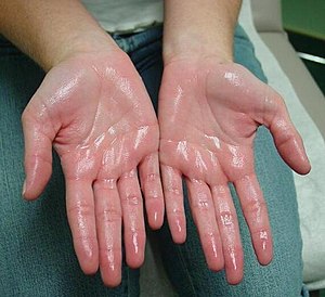 Hyperhidrosis Treatment Market