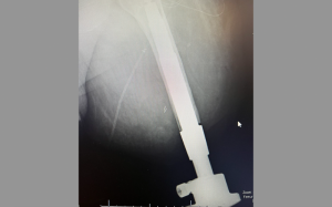 Osseointegration X Ray