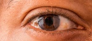 Eye Melanoma Market-By PMI