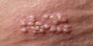 Genital Herpes Market-By PMI