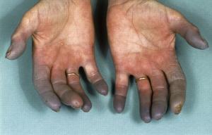 Global Raynauds Disease Market-PMI