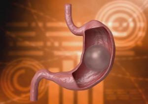 Gastric Balloon Market-By PMI