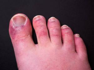 Diabetic Foot Ulcers Treatment Market-By PMI