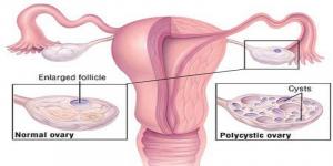 Polycystic Ovarian Syndrome (PCOS) Treatment Market1