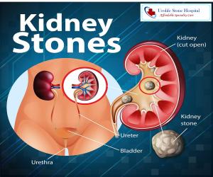 Urolife Stone Hospital - Leading the Way in Kidney Stone Treatment In Delhi