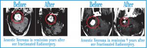 Acoustic Neuroma Before & After
