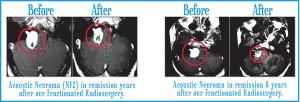 Acoustic Neuroma Before & After 2