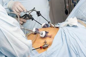 Laparoscopy Devices Market - PMI