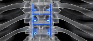 Spinal Fusion Devices Market1
