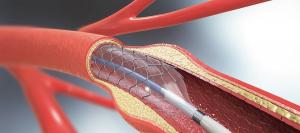 Stents Market1
