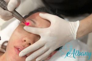 Albany Cosmetic and Laser Centre Introduces Innovative Vectorlift Treatment with Fotona