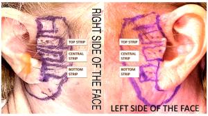 Image shows both ears, the area of the treated periauricular region of the skin with MIRApeel