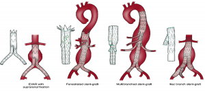 Endovascular Aneurysm Repair Market1