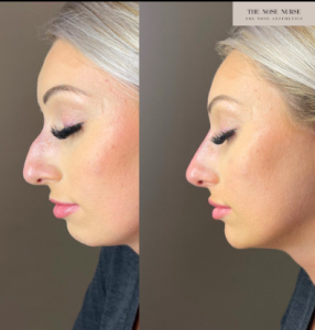 Before & After photo of an a instant nose job
