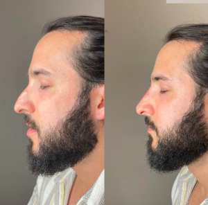 Before & After on a male nose