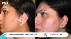 Vitiligo Treatment Market