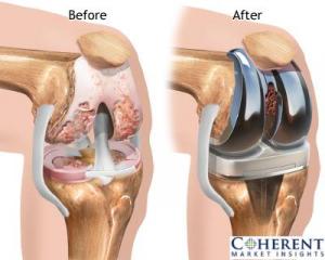 Artificial Joints Market