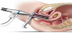 Transvaginal Endoscopy Market1