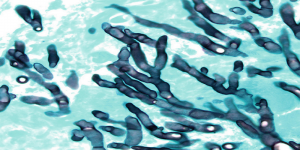 Mucormycosis Market1