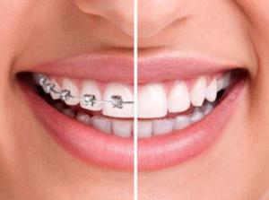 invisalign and braces in Reading, PA