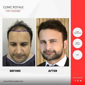 Clinic Royale -  Hair Transplant Before/After