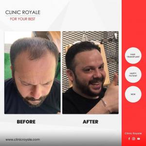 Take a look inside Clinic Royale offering international patients a hair transplant in Istanbul