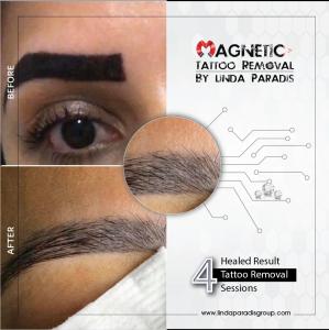Non-invasive Pain less liberation in Tattoo removal