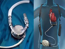 Ventricular Assist Device Market