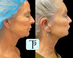 Dr. Penelope Treece, MD, Embracing Non-Surgical Facelifts and Redefining the Norm