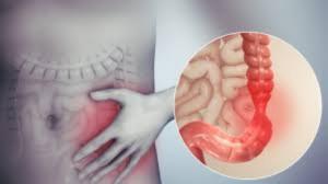 Irritable Bowel Syndrome Treatment Market