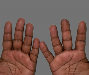 The second photograph portrays a patient who has undergone fingertip regeneration by Dr. Srinjoy Saha. The individual, with a smile of satisfaction, holds out their hand, showcasing the fully restored and natural-looking fingertip. The photo captures the 