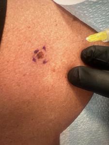 Skin Cancer Lesion & Treatment | Quinn Dermatology