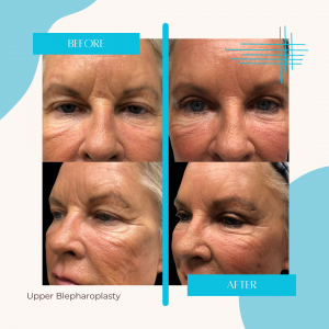 Upper Blepharoplasty