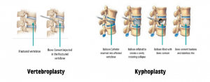 Vertebroplasty and Kyphoplasty Market2