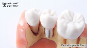 Dental Implants Perth