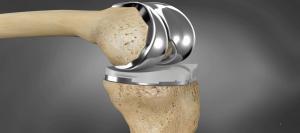 Knee Replacement Devices Market2