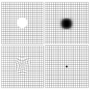 Amsler Grid shows distortion, missing or blurred images with macular problems. (C) 2023 Retina Group of New York