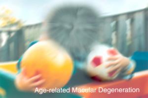 Dry Age-Related Macular Degeneration (AMD) with Geographic Atrophy (GA)can cause central blindspots