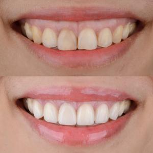 Gummy Smile Treatment in Beverly Hills by Dr. Alex Farnoosh