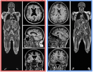 Images of two women, one with excessive body fat, indicate link between fat and brain atrophy
