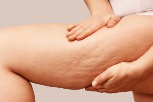 Dr. Akoury’s Home Remedies for Cellulite Success