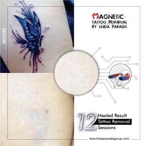 Magnetic Tattoo Removal 02