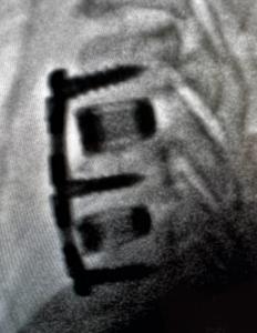 Ti-Largo Implanted Cervical Cage