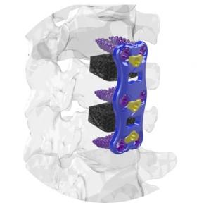 Ti-Largo 3D Printed Cervical Cage