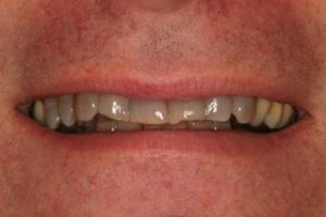 Before Ceramic Crowns by Dr. David P. Ney, DDS
